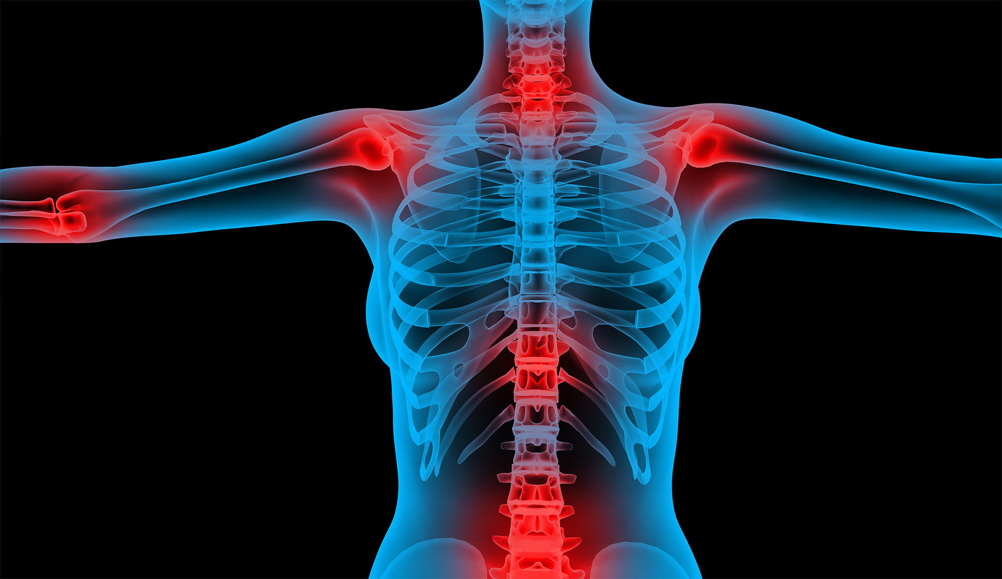 Osteoporosis 101: How Osteoporosis Works