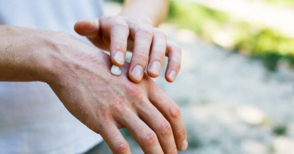 applying cream on hands with psoriasis